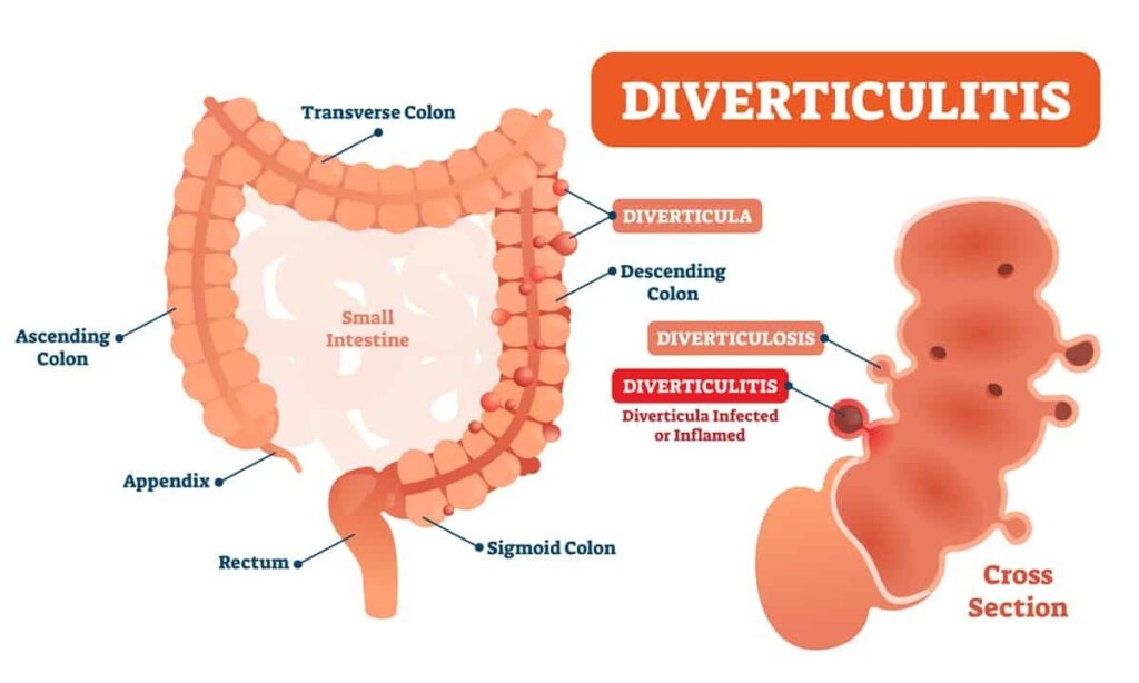 malattia-diverticolare-e-diverticolite-dr-antonio-romano